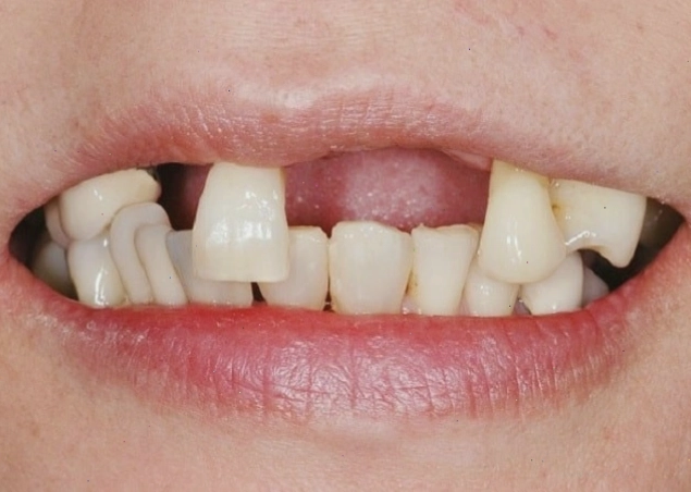Mơ rụng răng hàm trên có thể là dấu hiệu cần chú ý đến sức khỏe răng miệng.