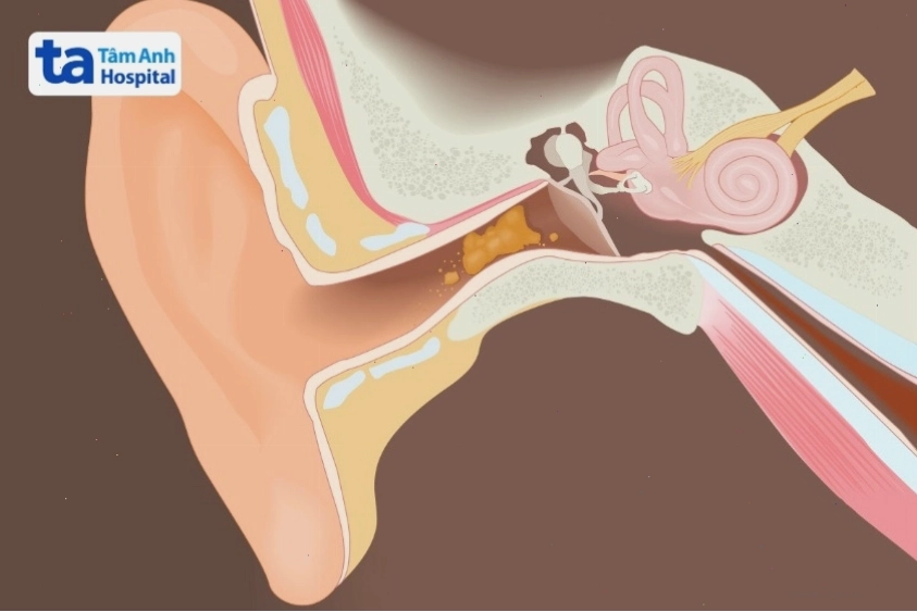 Nhiều nguyên nhân gây ù tai trái cần được bác sĩ chuyên khoa chẩn đoán