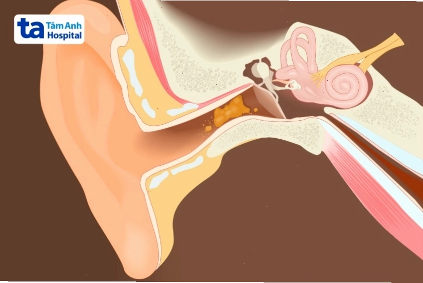 Sơ đồ giải phẫu tai người, chỉ rõ các bộ phận có thể bị ảnh hưởng gây ù tai trái