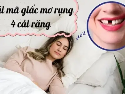 Giải mã giấc mơ rụng 4 cái răng - Liệu đây là điềm xấu?