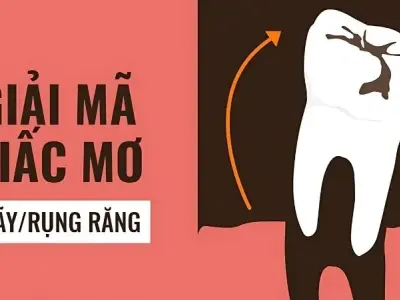 Nằm mơ gãy răng là điềm báo tốt hay xấu? Giải mã ý nghĩa